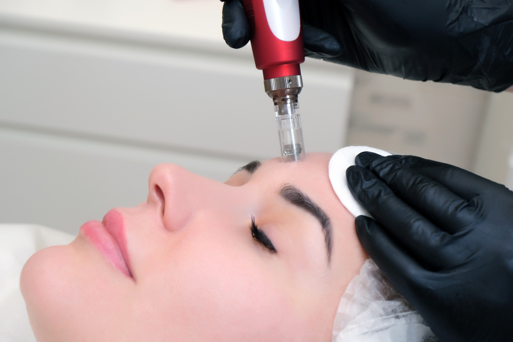Microneedling for Skin Health and Regeneration